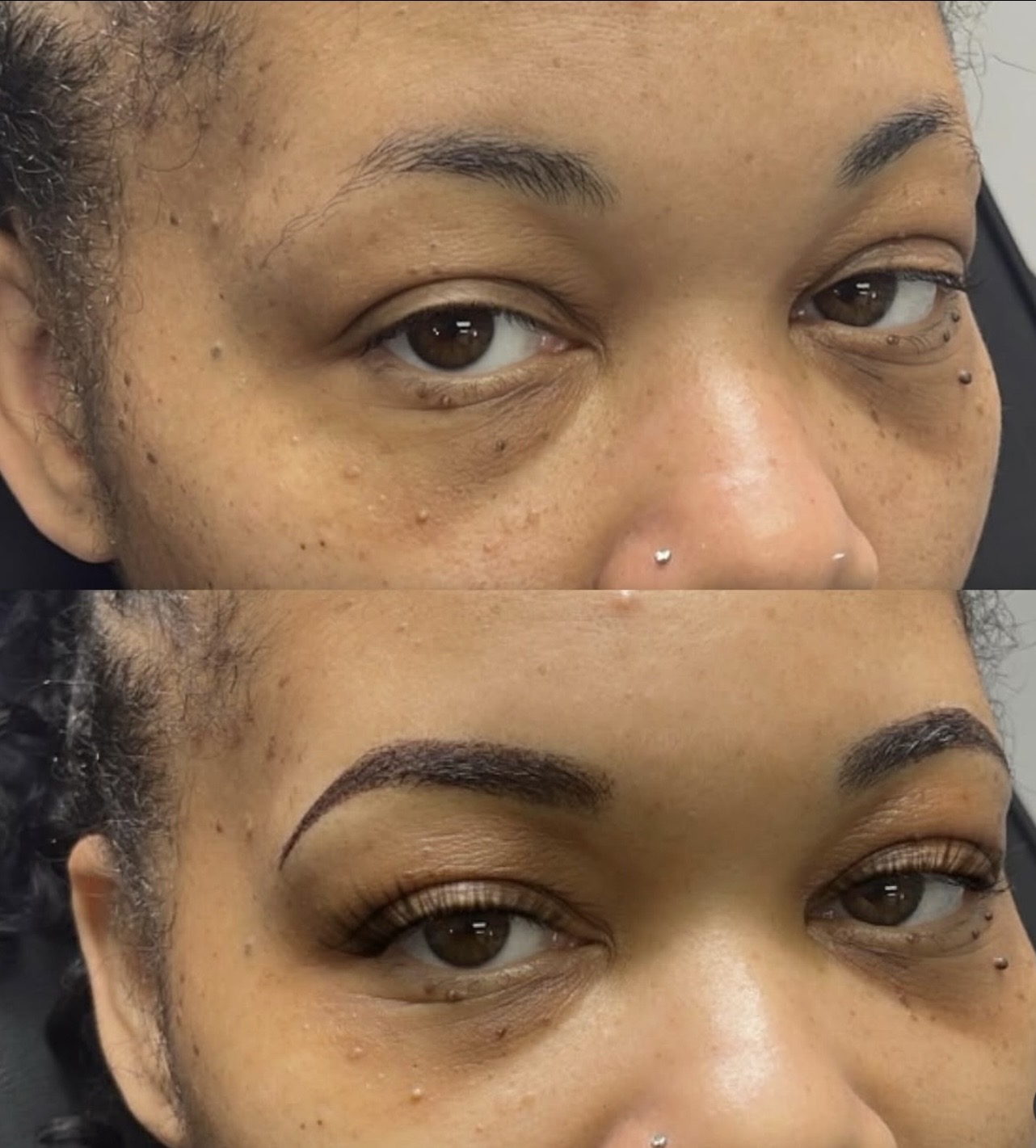 Brow restoration