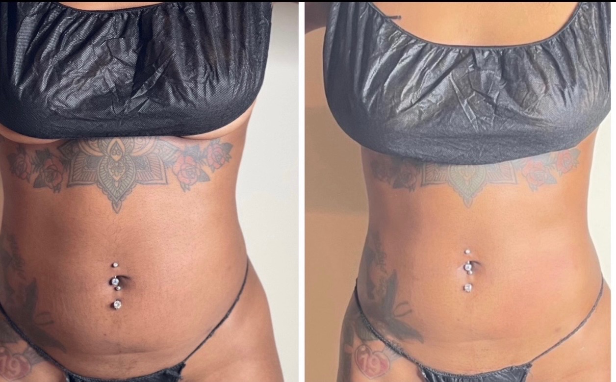 Body sculpting result