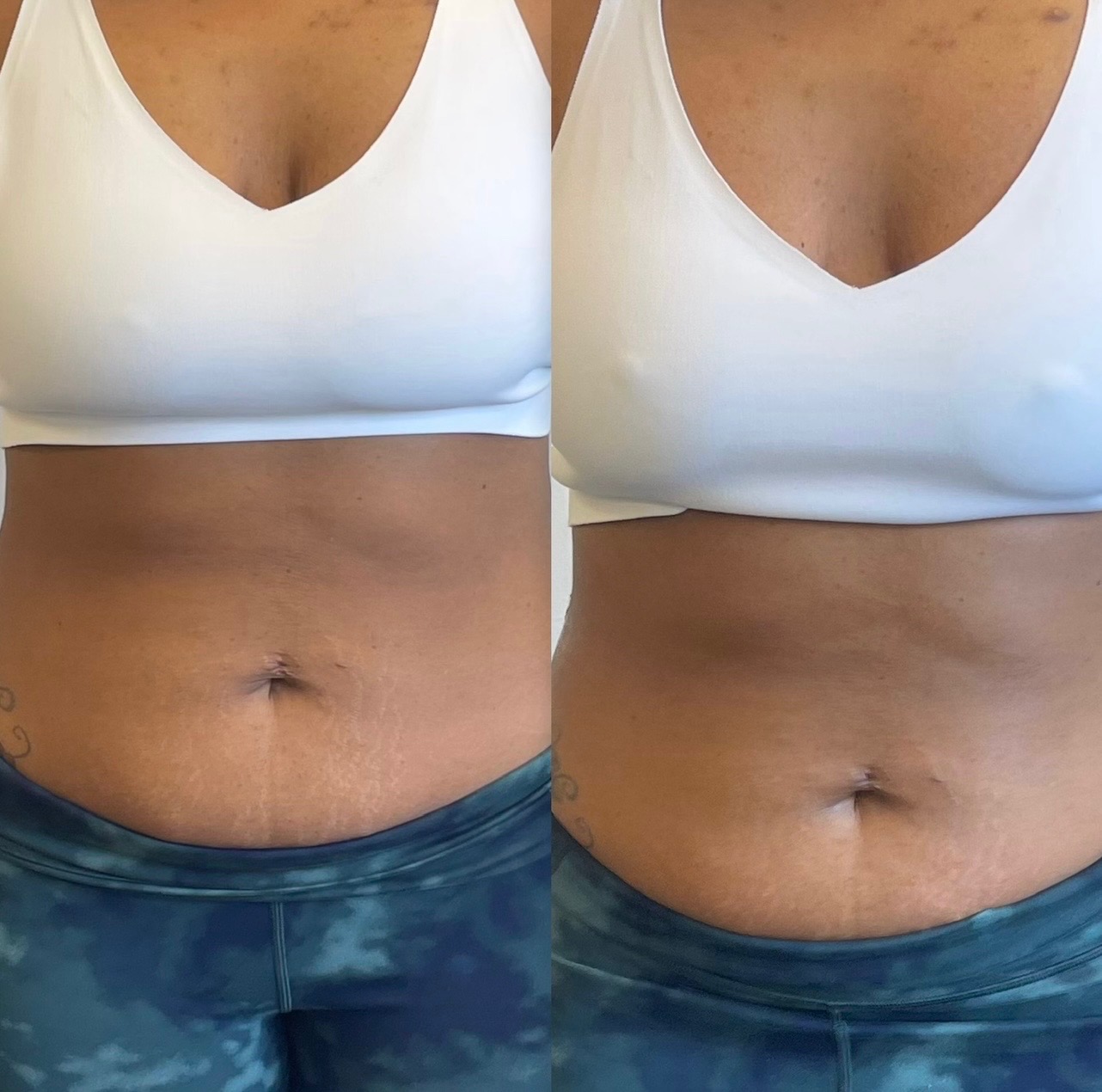 Abdominal sculpting